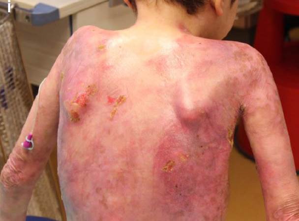 7-Year-Old-Boys Life Was Saved By Skin Grown In A Lab