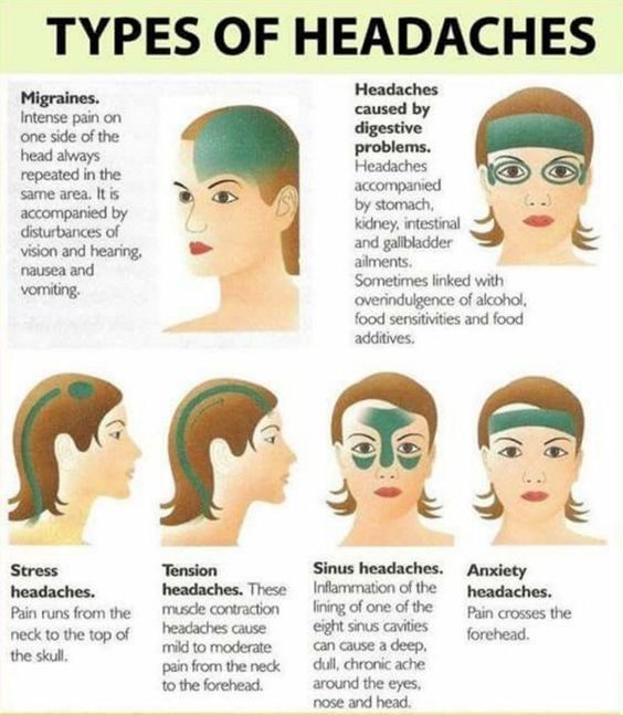 Headache Regions Chart