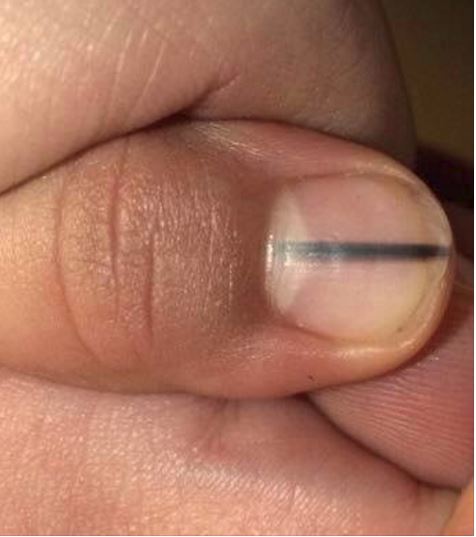 If You See A Black Line On Your Nail, Call Your Doctor Immediately