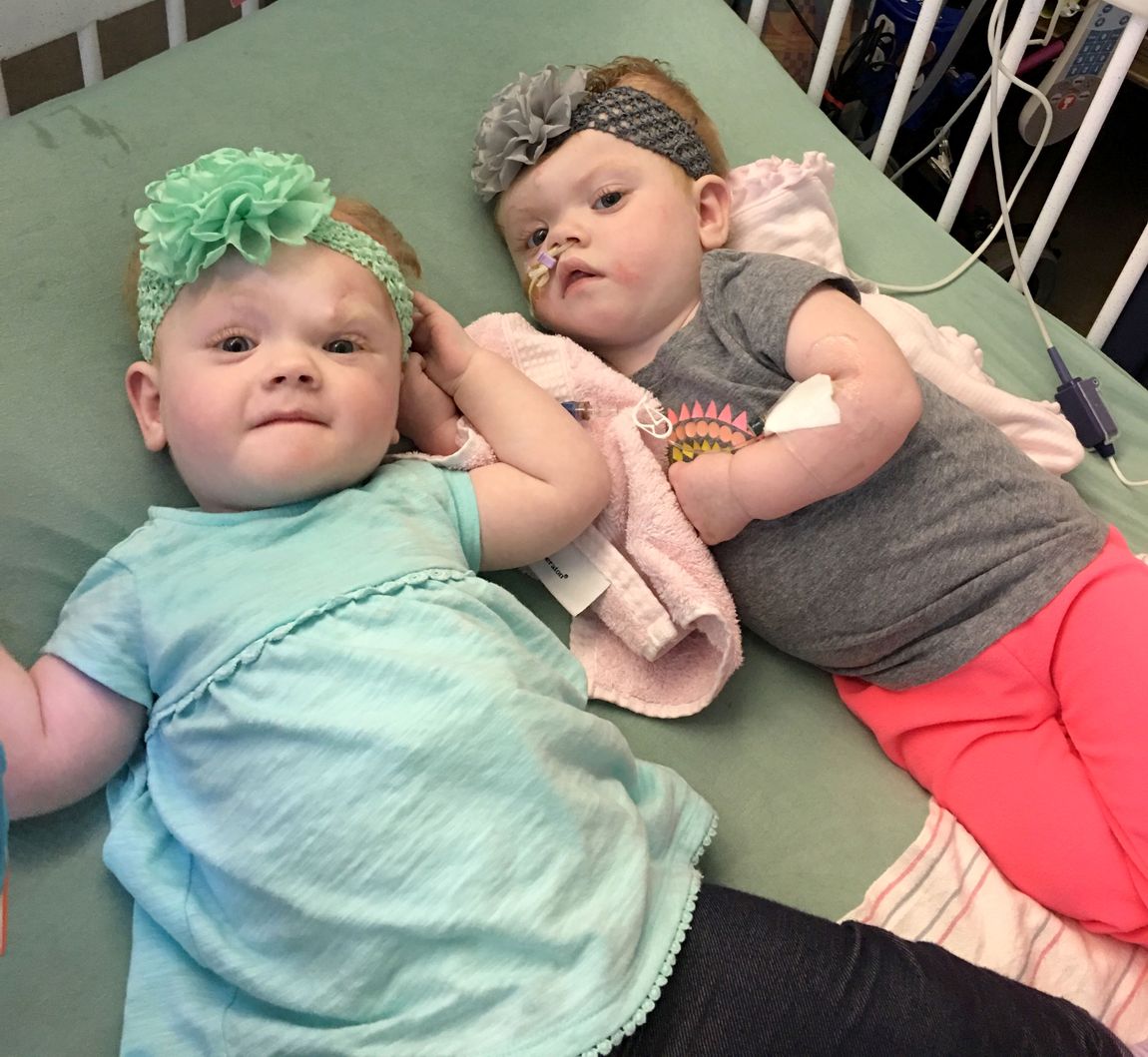 Formerly Conjoined Twins Update - Ellen Kathlin