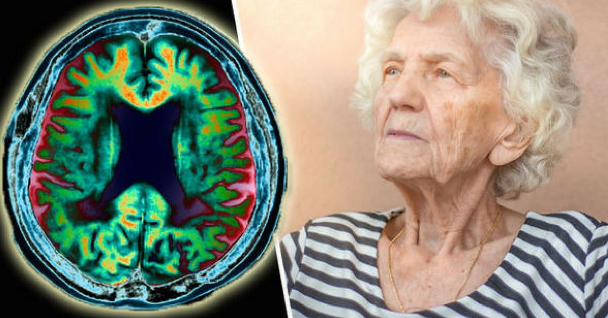 Деменция исследования. Болезнь Альцгеймера деменция. Деменция в старости. Болезнь Альцгеймера фото. Мозг в старости.
