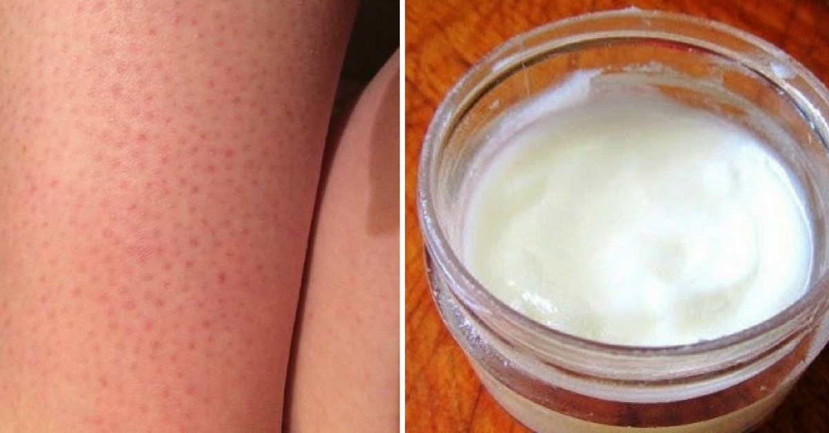 The Easiest Ways To Get Rid Of Strawberry Legs At Home