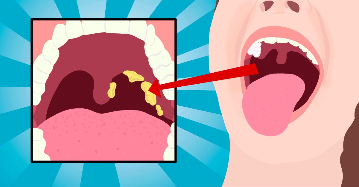 How to remove tonsil stones at home - Tonsil stone removal - YouTube