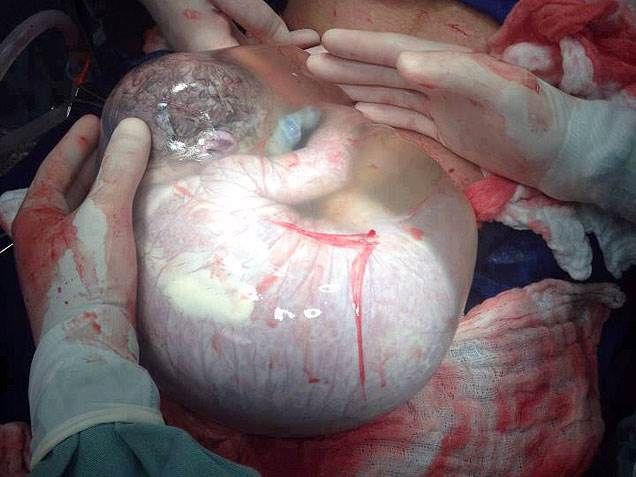 amniotic sac
