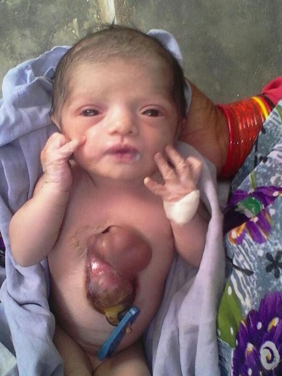 heart outside of baby's body
