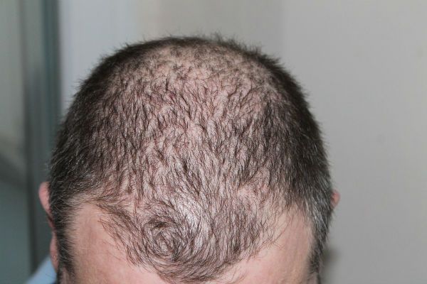 Male baldness