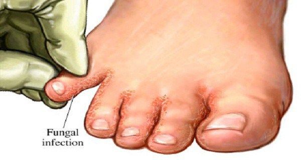 Animated fungal foot infection