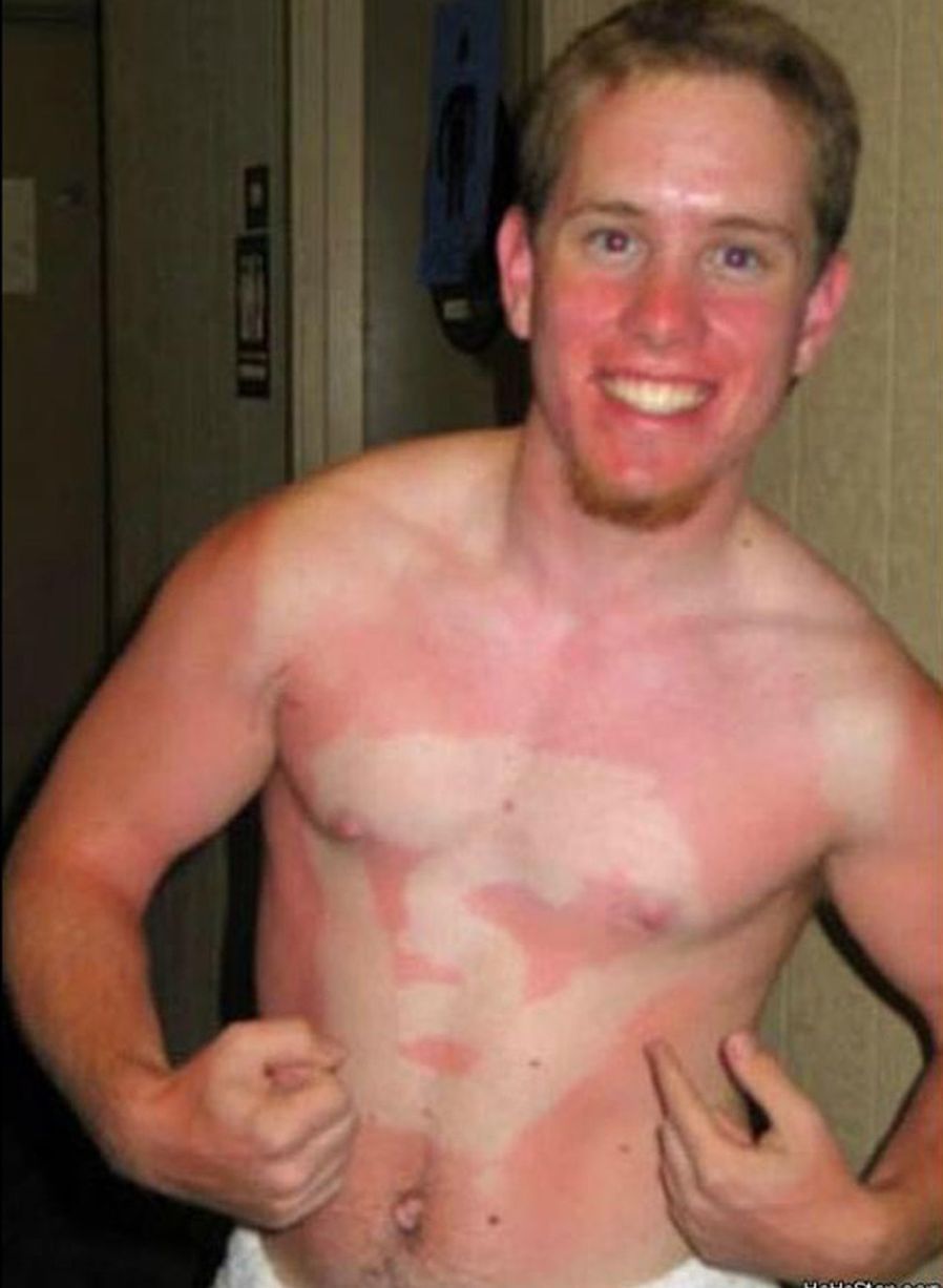 A sun tan line of the superman symbol