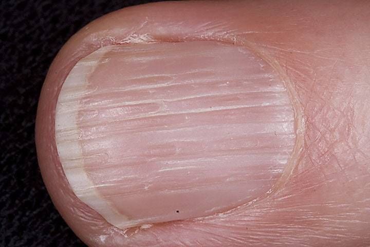 How Your Fingernails Are Trying To Warn You About Your Health