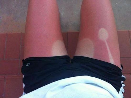 20 Hilarious Tan Lines Thatll Make You Never Want To Step Outside Again 