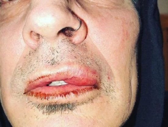 Tommy Lee's busted lip