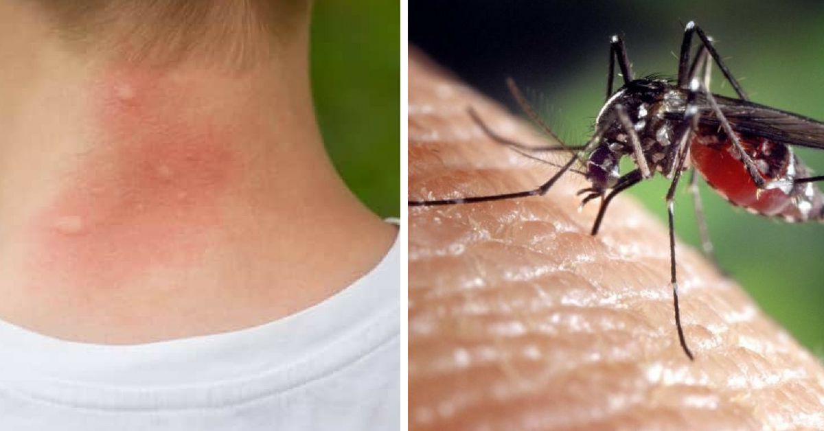 Teenager The First Human To Be Diagnosed With New Mosquito Virus