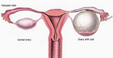 A diagram of an ovarian cyst
