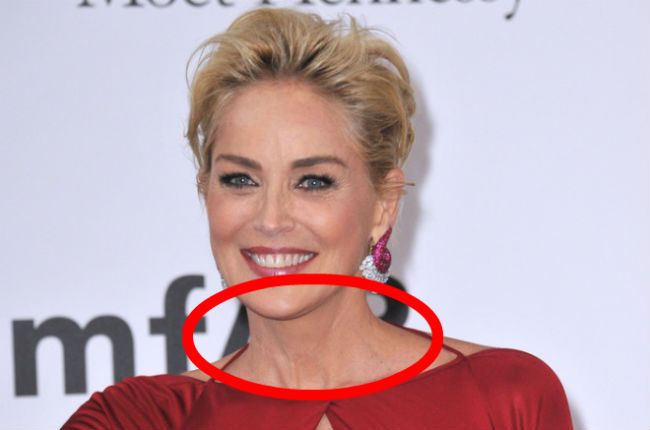 Sharon Stone scar