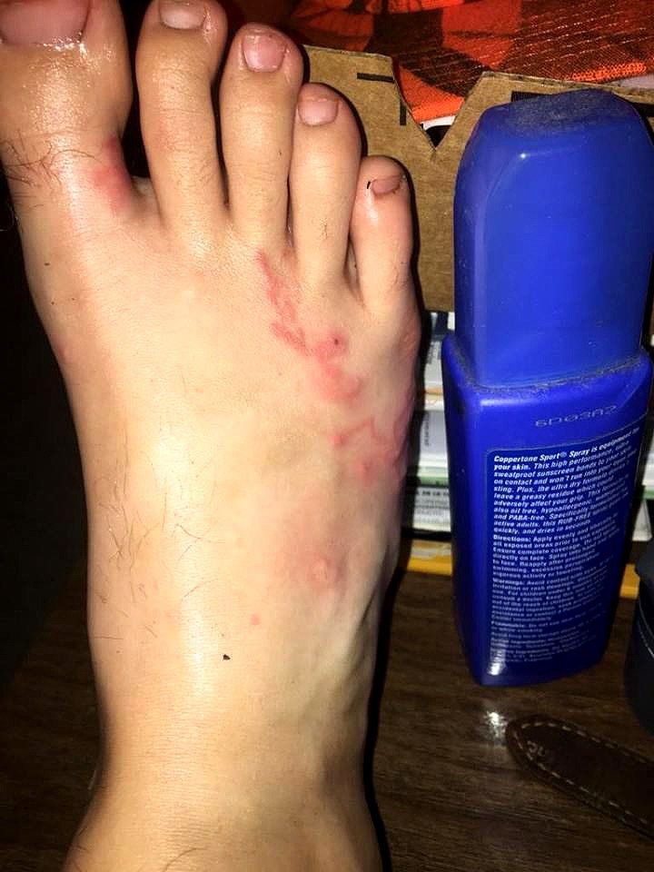 Michael's foot