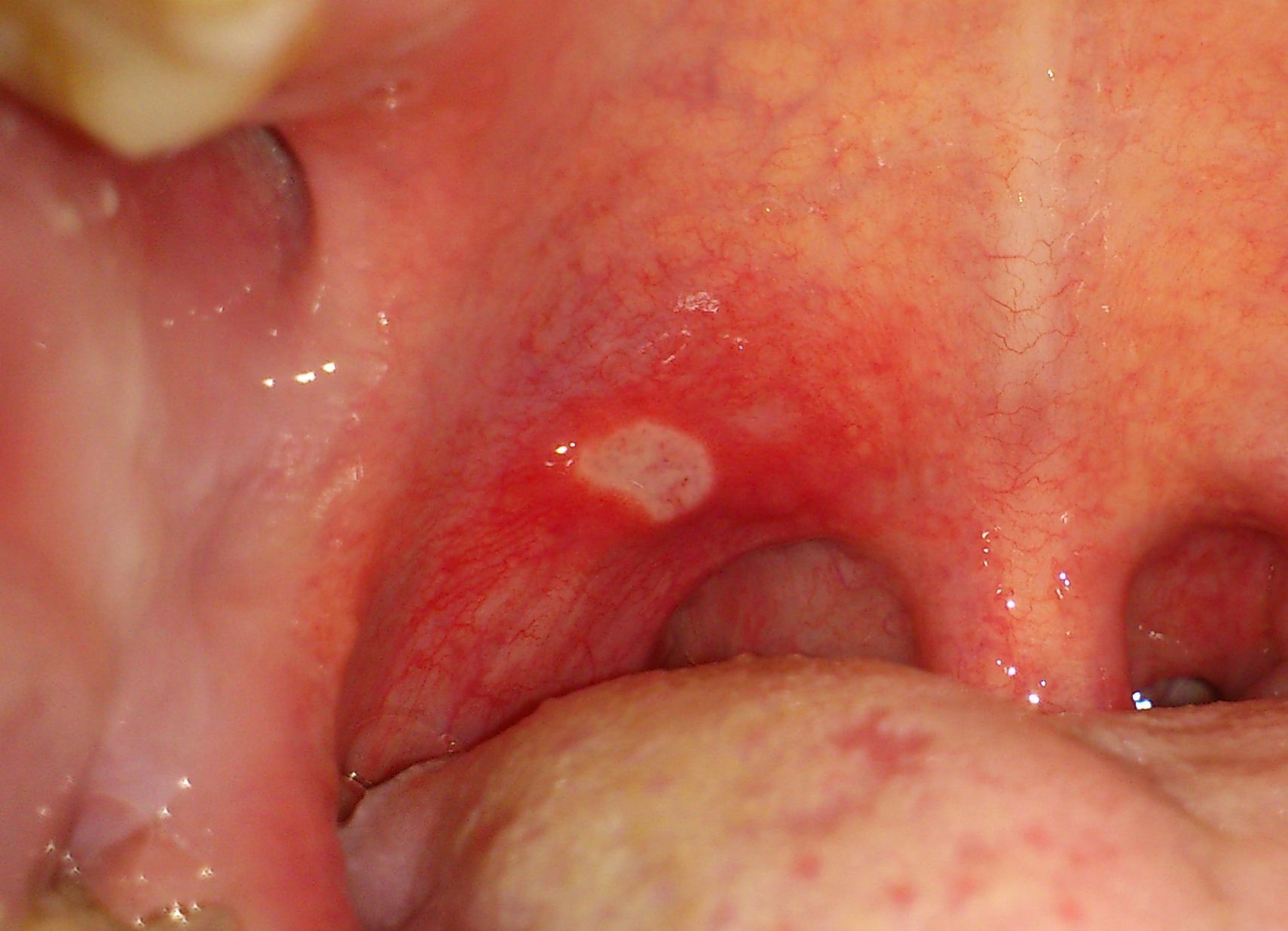 Canker sore