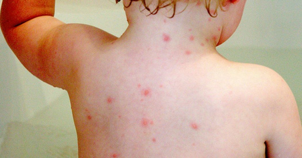 11 Month Old Suffers Stroke After Contracting Chicken Pox From