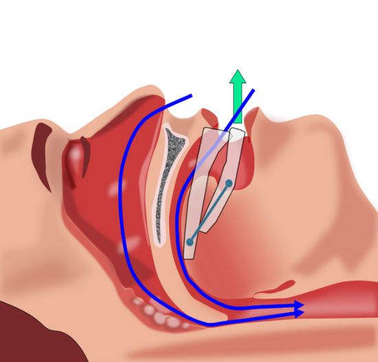 Sleep apnea