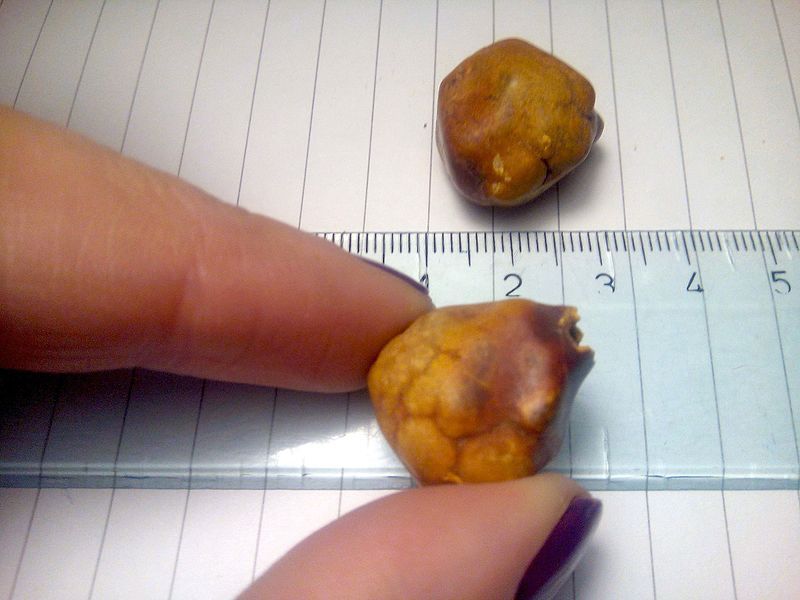 Gallstones