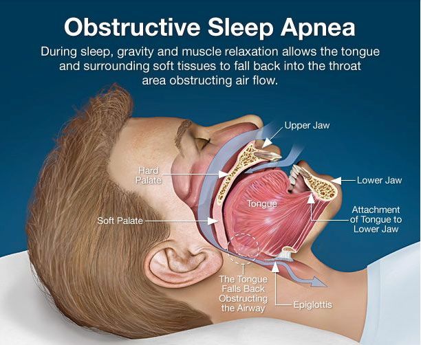 Sleep apnea