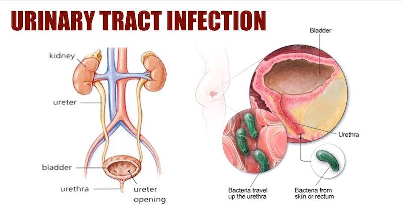 UTI diagram