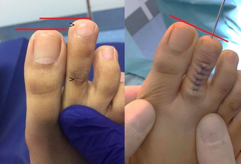 Toe surgery before and after