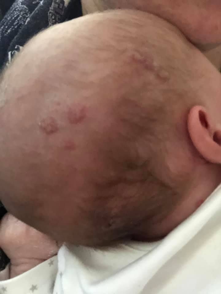 herpes virus on baby 