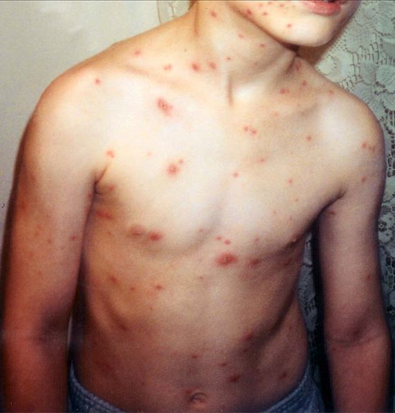 chickenpox 