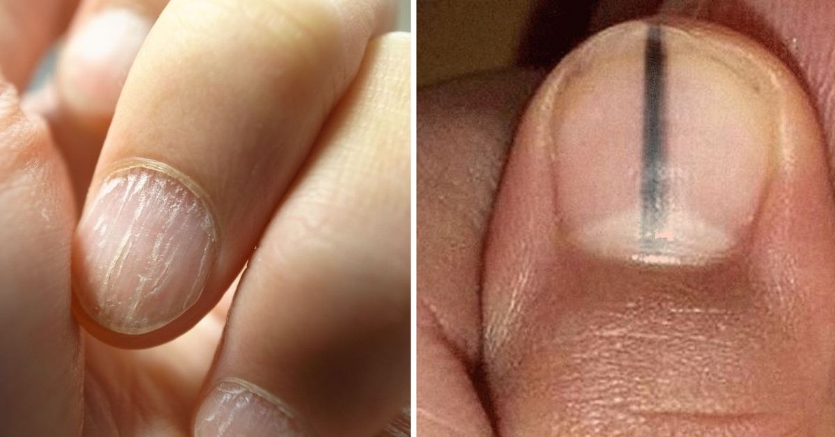 Dents fingernails tiny in Nail Pitting: