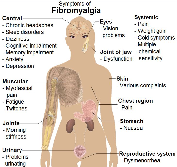 Diagram of fibromyalgia