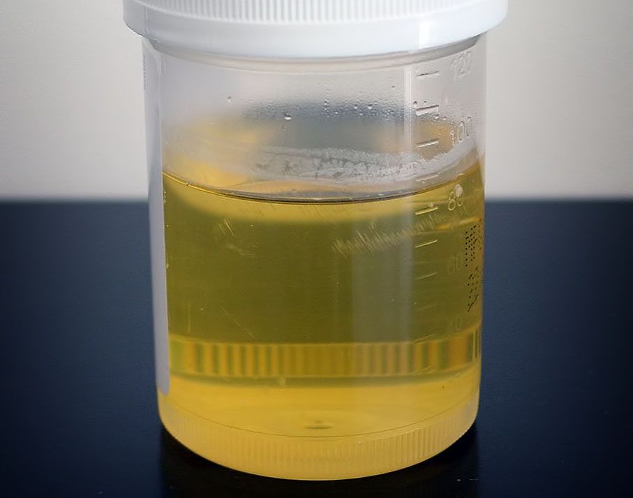 Urine sample