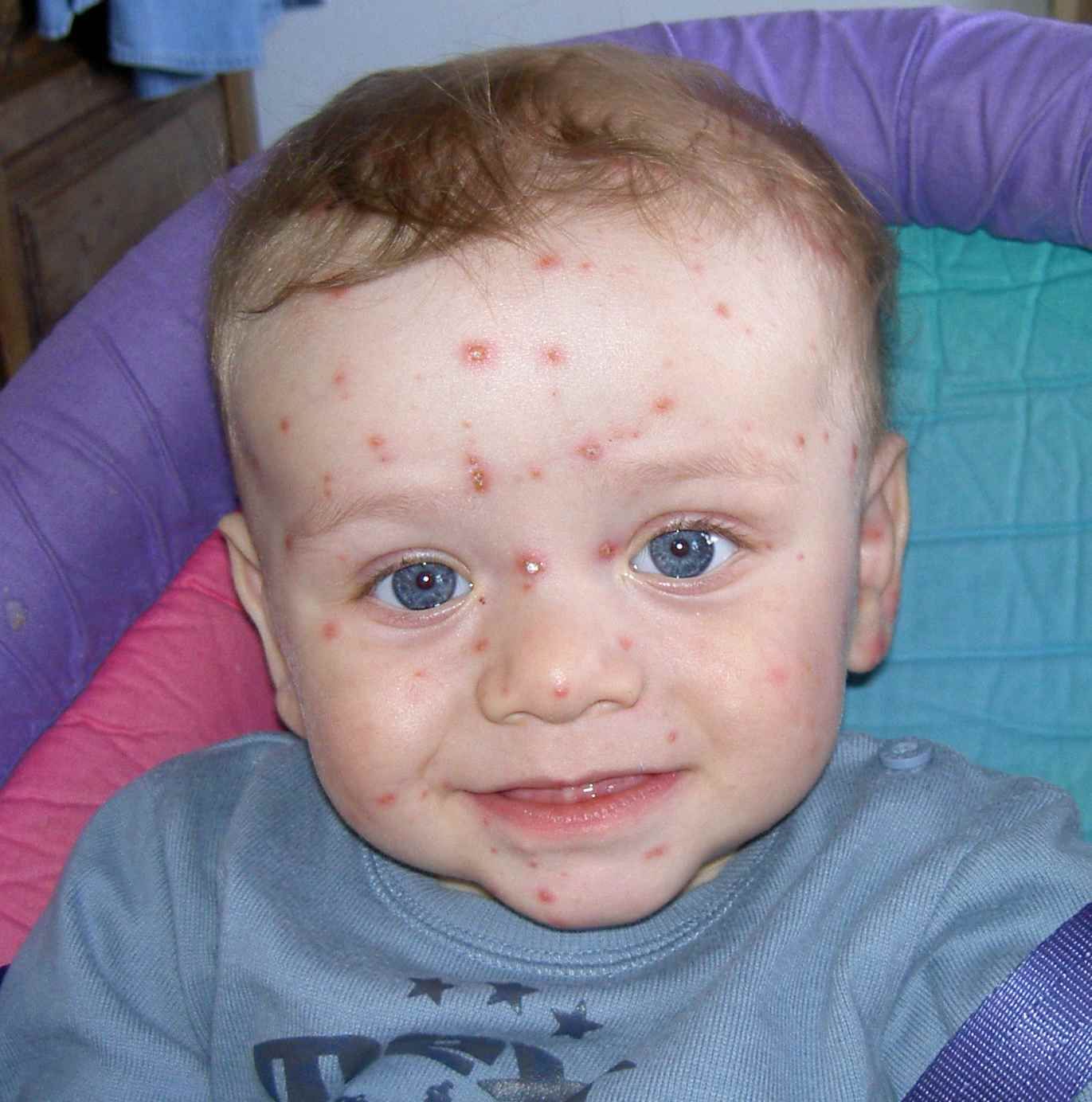 chickenpox child 