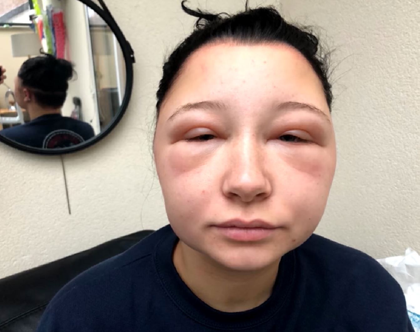 Estelle Allergic Reaction