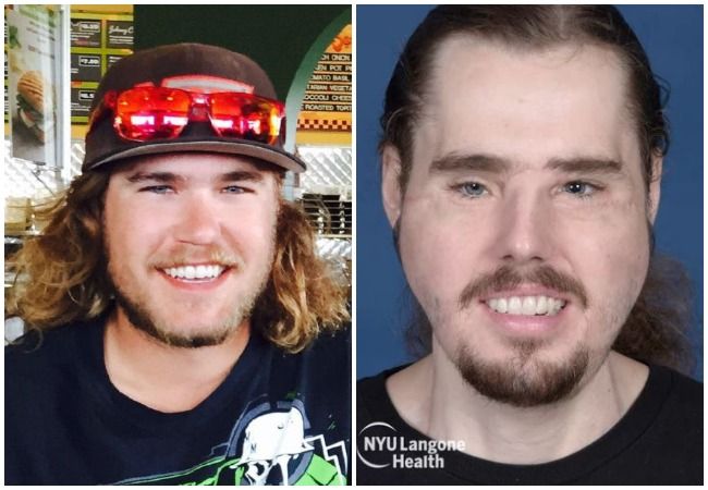 Cameron Underwood facial transplant