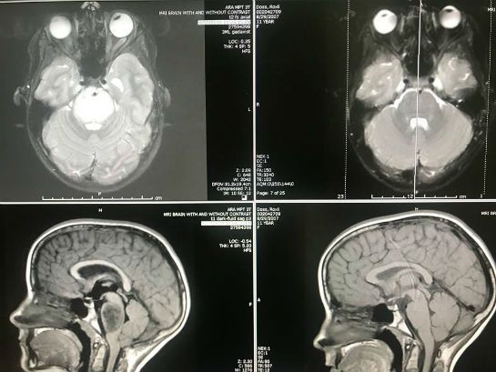 Brain Tumor miracle