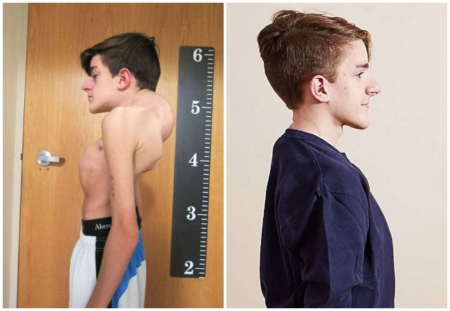 Scoliosis Before and After