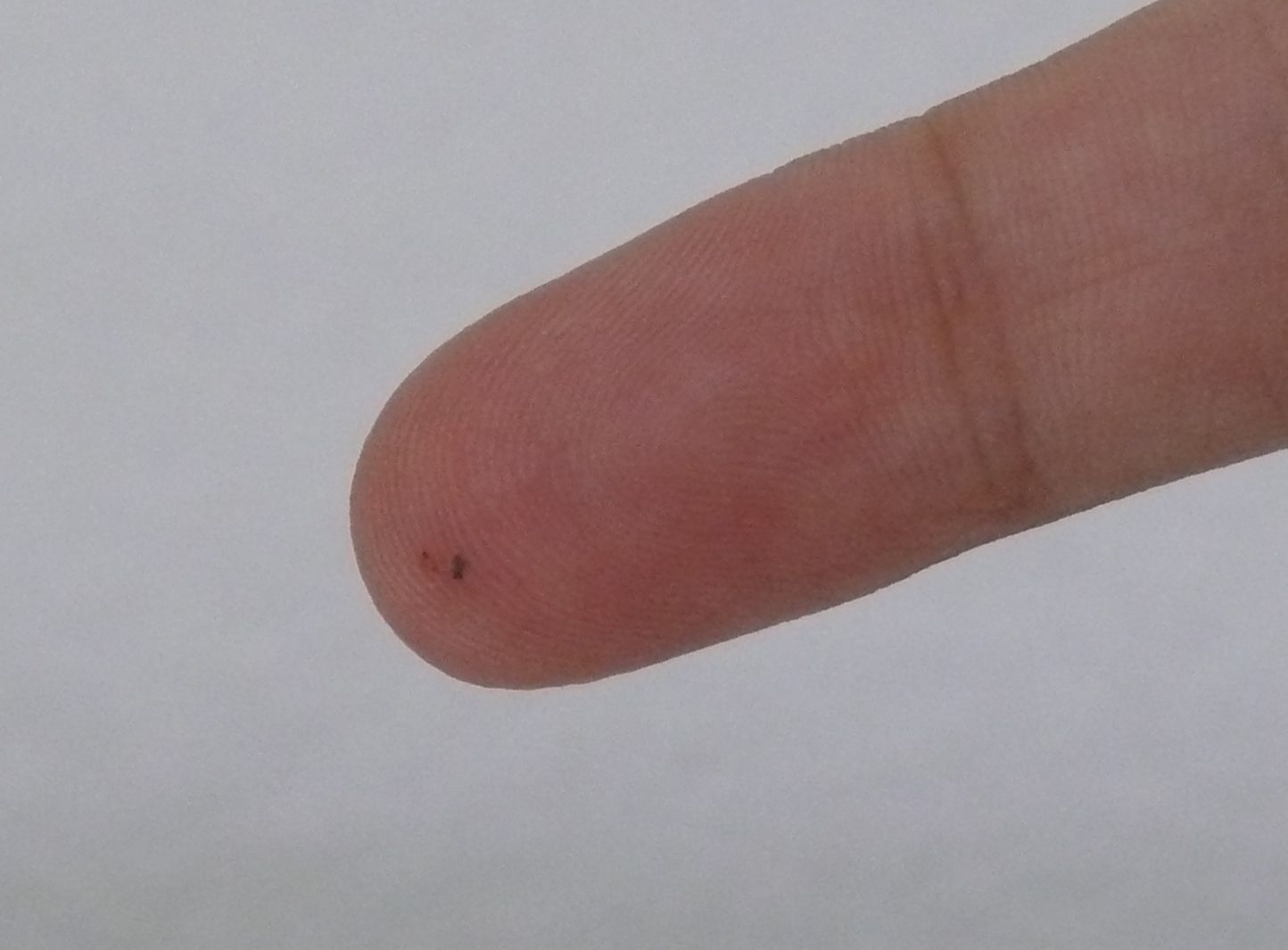 Splinter in a finger