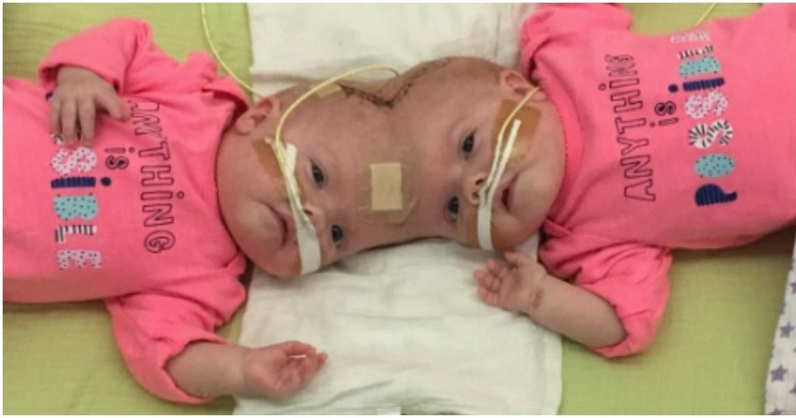 A Year After Their Separation Conjoined Twins Celebrate Their New Lives