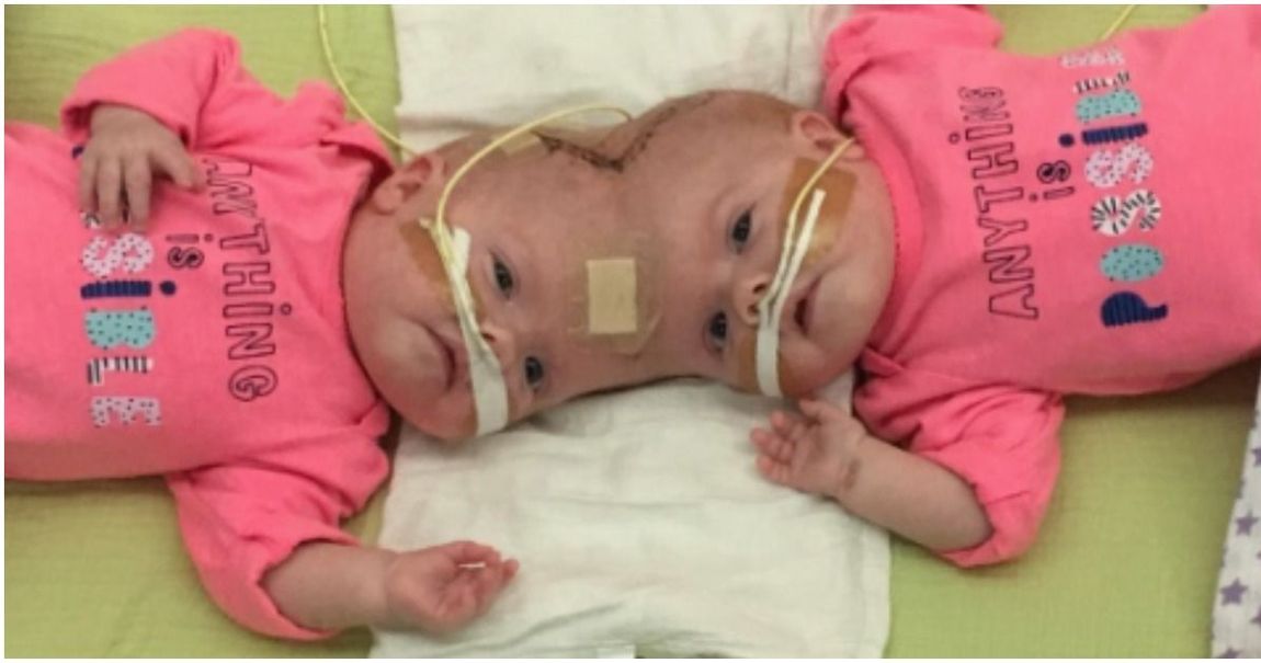 A Year After Their Separation Conjoined Twins Celebrate Their New Lives 