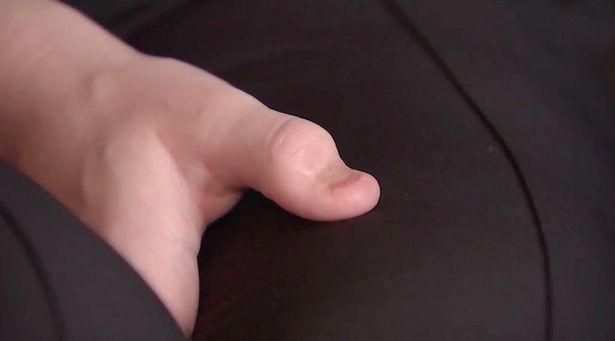 Karolina Jasko's thumb
