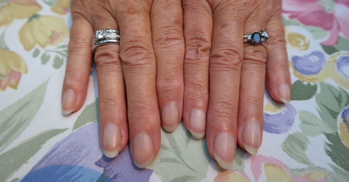 Common Nail Problems and How to Treat Them - wide 4