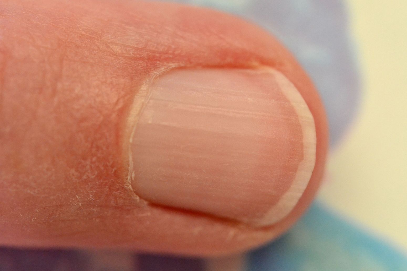 Common Nail Problems and How to Treat Them - wide 7
