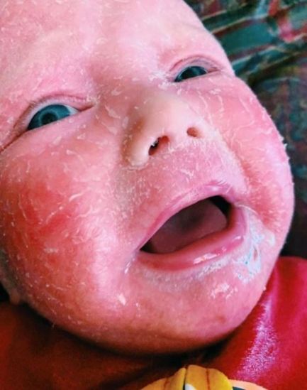 Ichthyosis